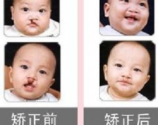 吃兔肉真的會(huì)長(zhǎng)兔唇？為什么會(huì)長(zhǎng)兔唇？